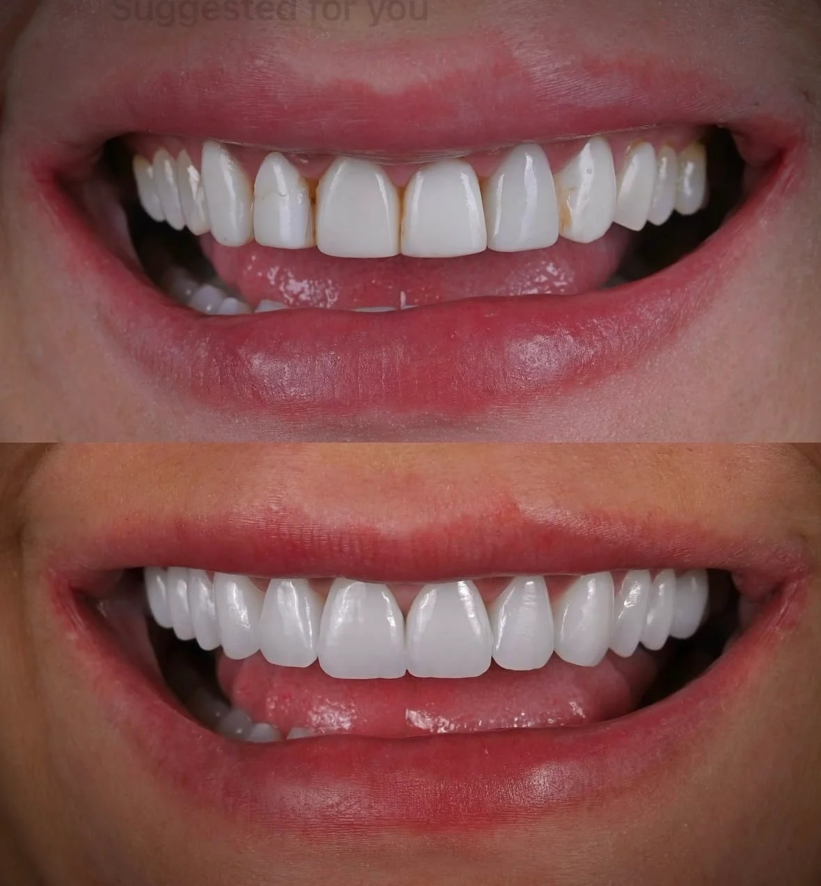 Full transformation: before treatment, discoloration along the gumline and minor spacing detracted from the smile; after treatment, custom porcelain veneers delivered ideal length, subtle translucency, and natural vitality for a highly sophisticated aesthetic.